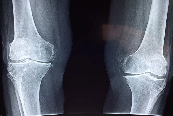 Orthopedic Physiotherapy